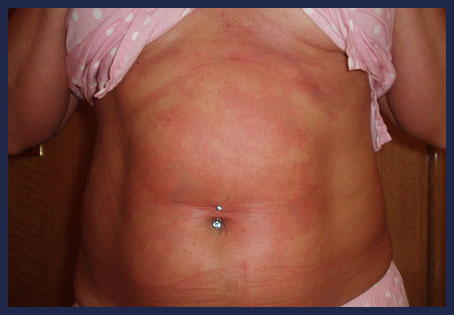 Skin Bends, Decompression Illness (DCI) Skin Bends, Decompression Illness (DCI)